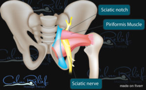 Sciatica pain caused by inflamed muscle pressing the nerve